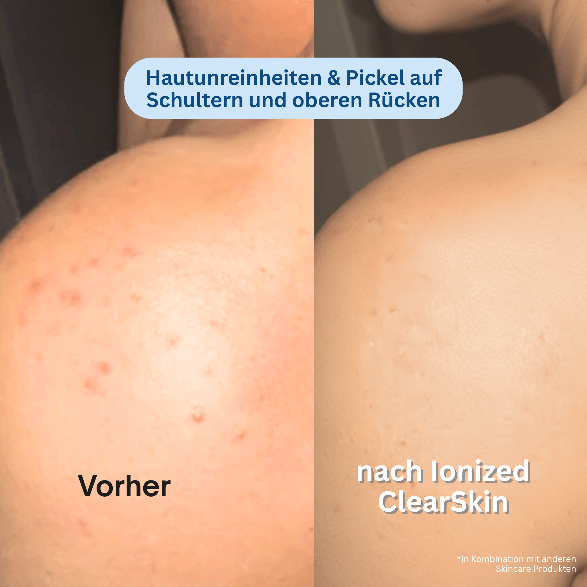 Ionized™ Peeling Duschtücher - Full Routine