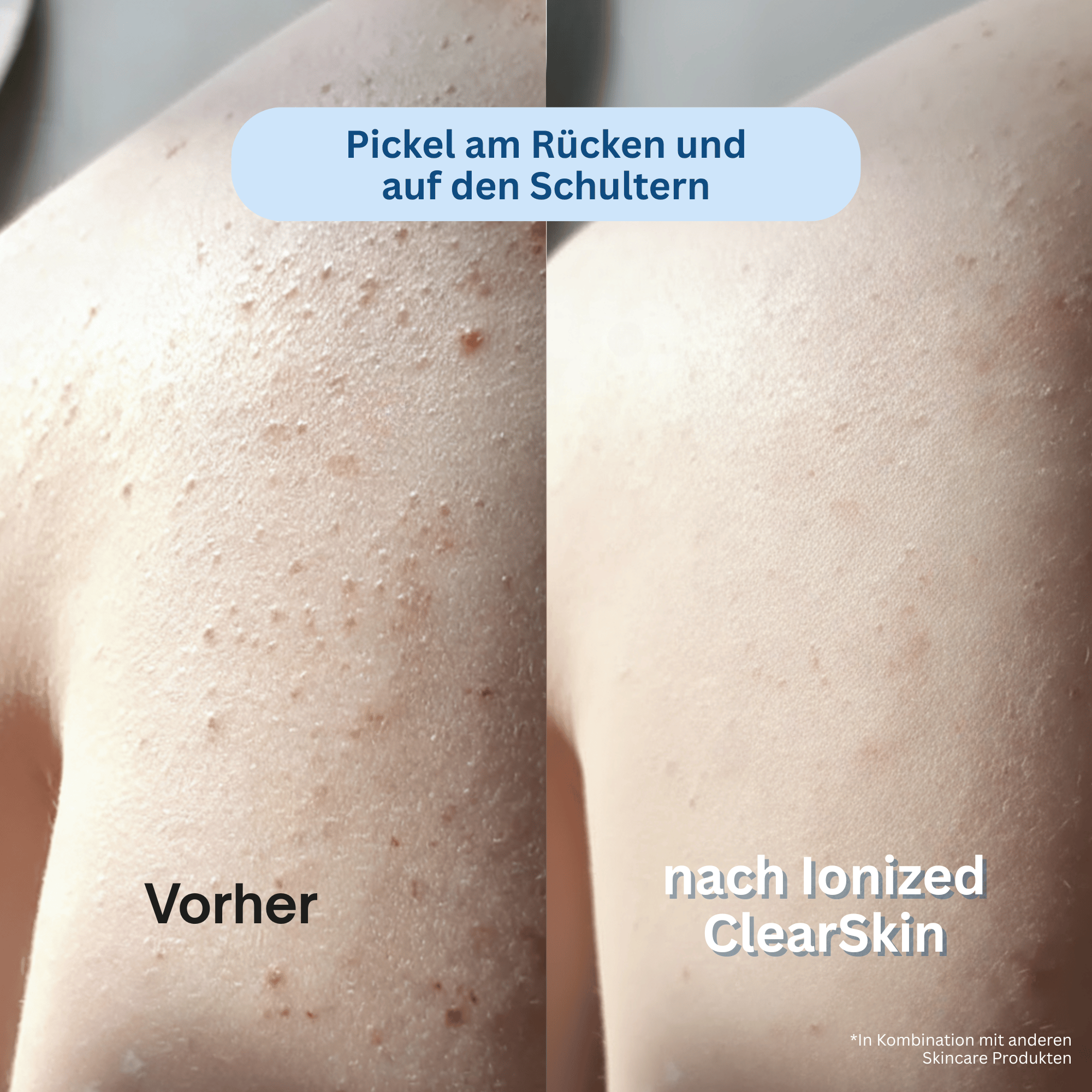 Ionized™ Peeling Duschtuch - Pickel / Akne
