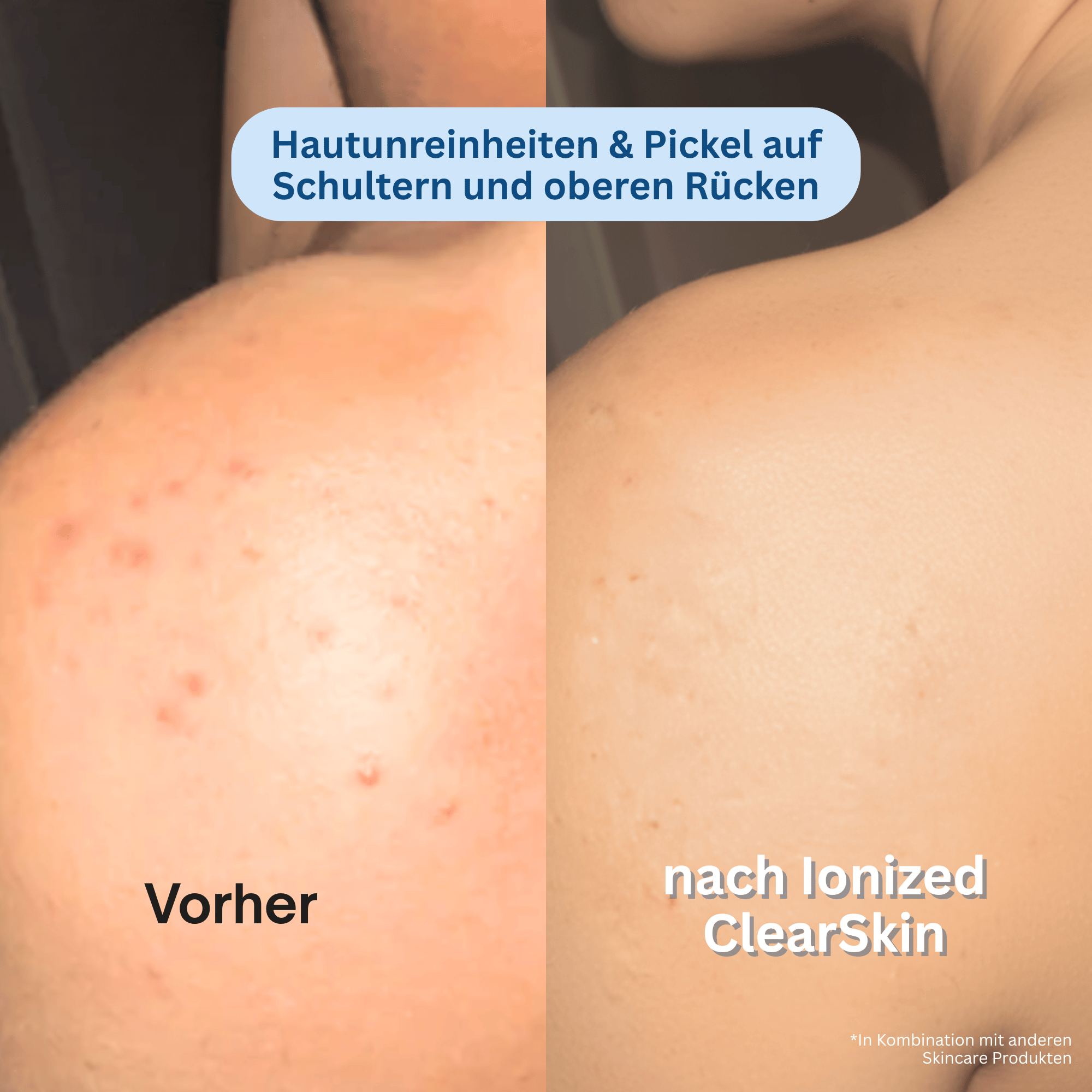 Ionized™ Peeling Duschtuch - Pickel / Akne