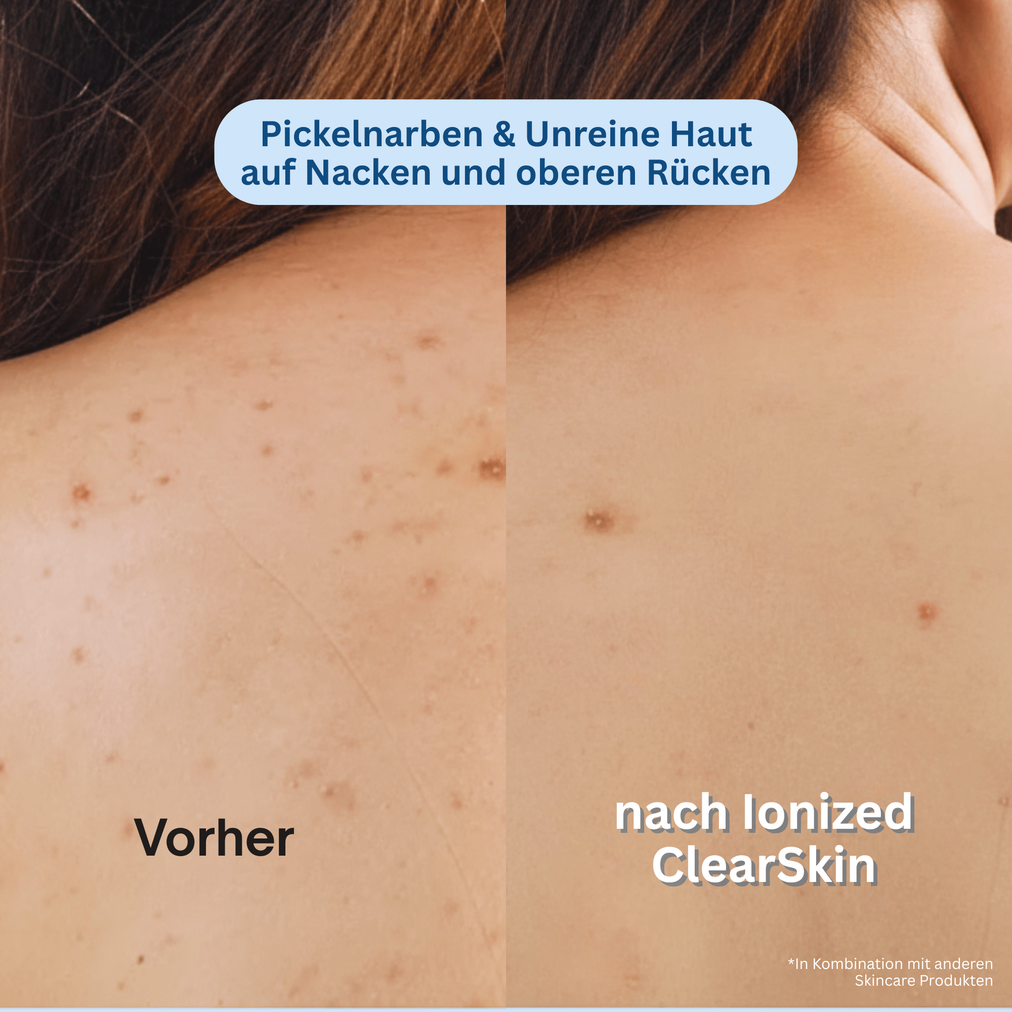 Ionized™ Peeling Duschtuch - Pickel / Akne
