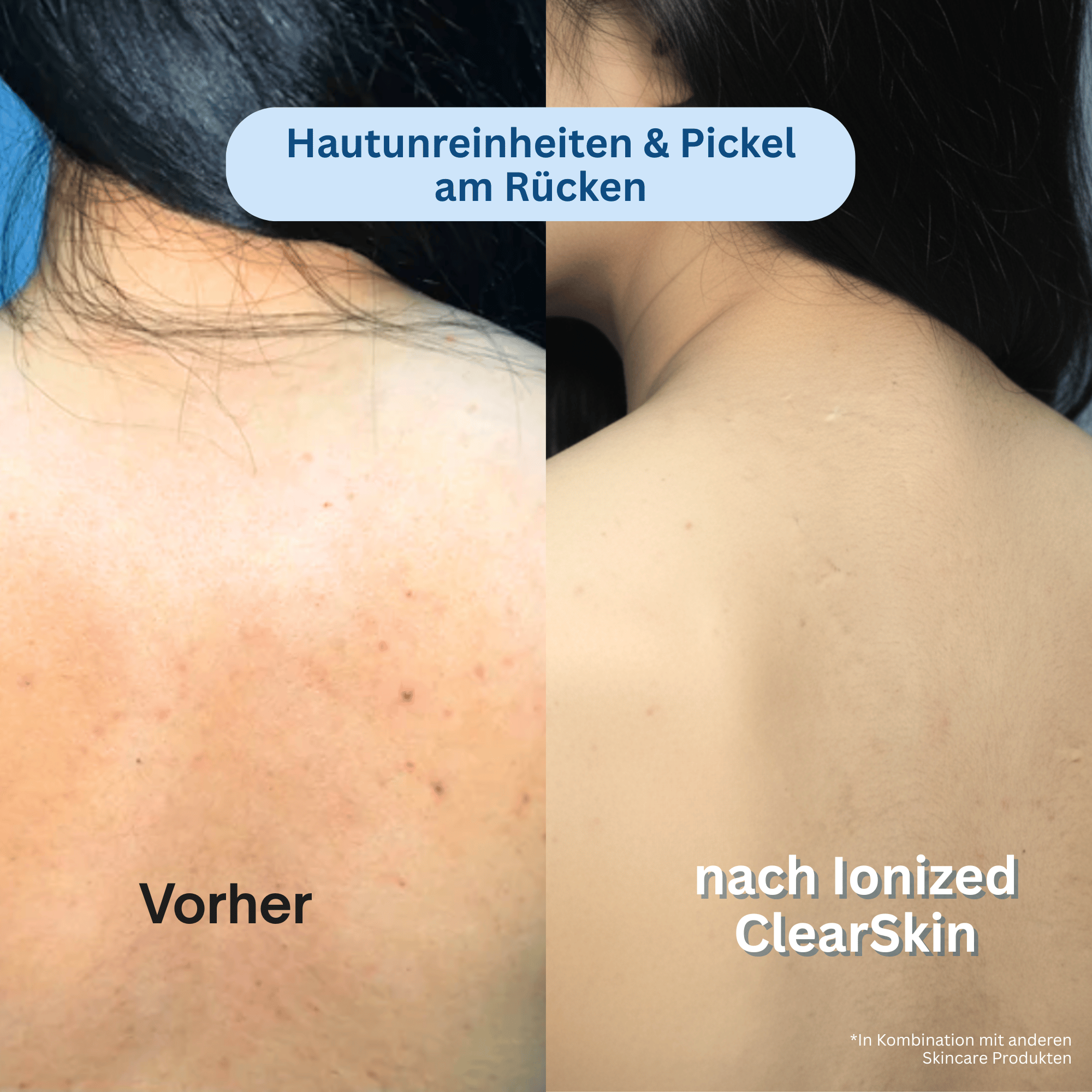 Ionized™ Peeling Duschtücher - Full Routine