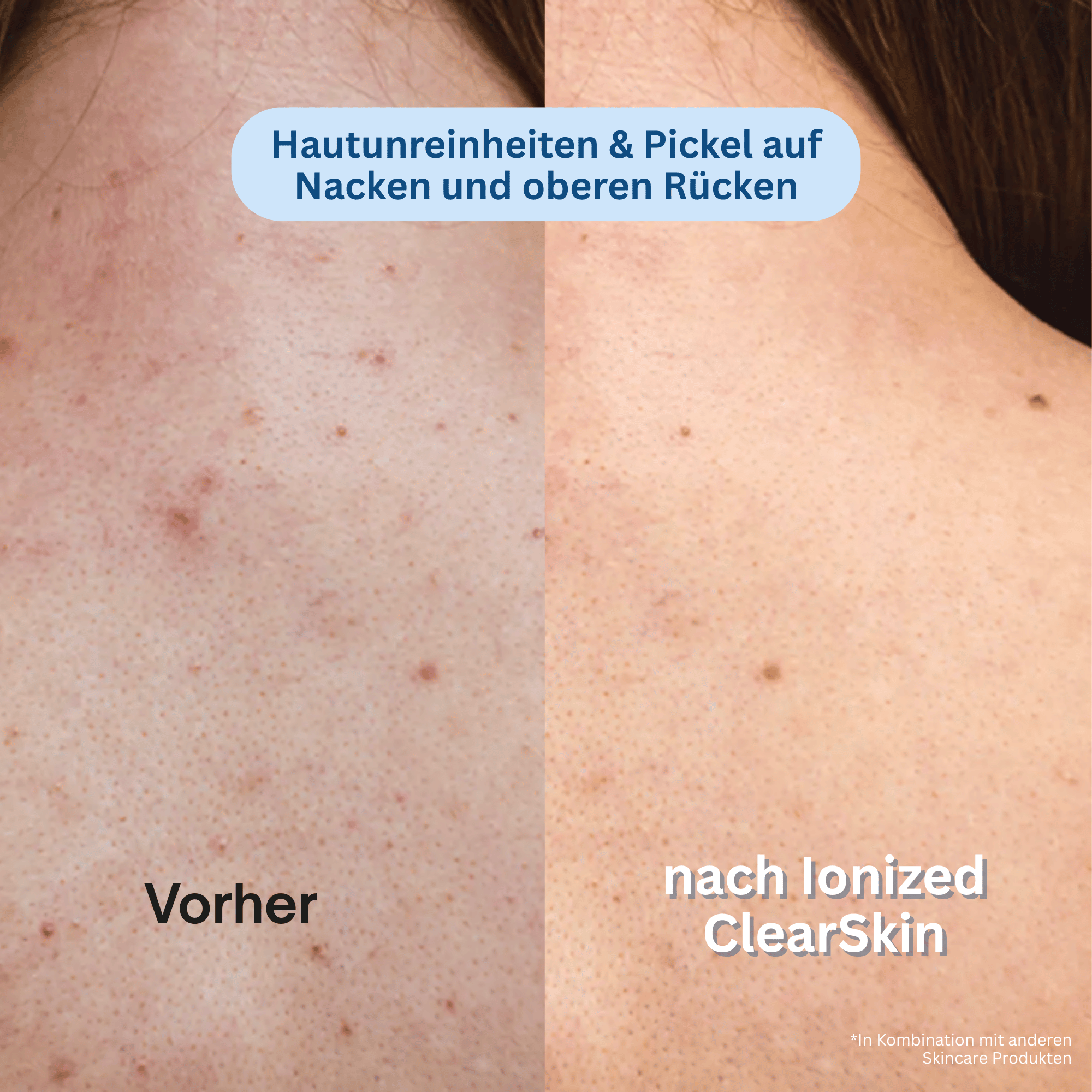 Ionized™ Peeling Duschtuch - Trockene & Unreine Haut